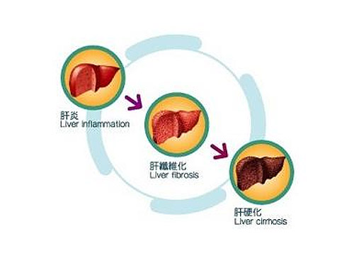 Prevention and treatment of liver cirrhosis is actually very simple