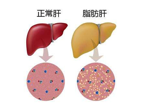 有脂肪肝了怎么办？